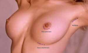 cicatrices prothèses mammaires