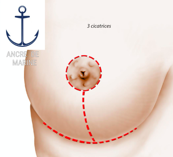 cicatrice en ancre de marine pour lifting mammaire Bordeaux