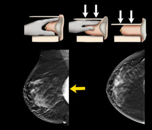 INCIDENCE D'EKLUND DETECTION DE CANCER DU SEIN / PROTHESES MAMMAIRES BORDEAUX